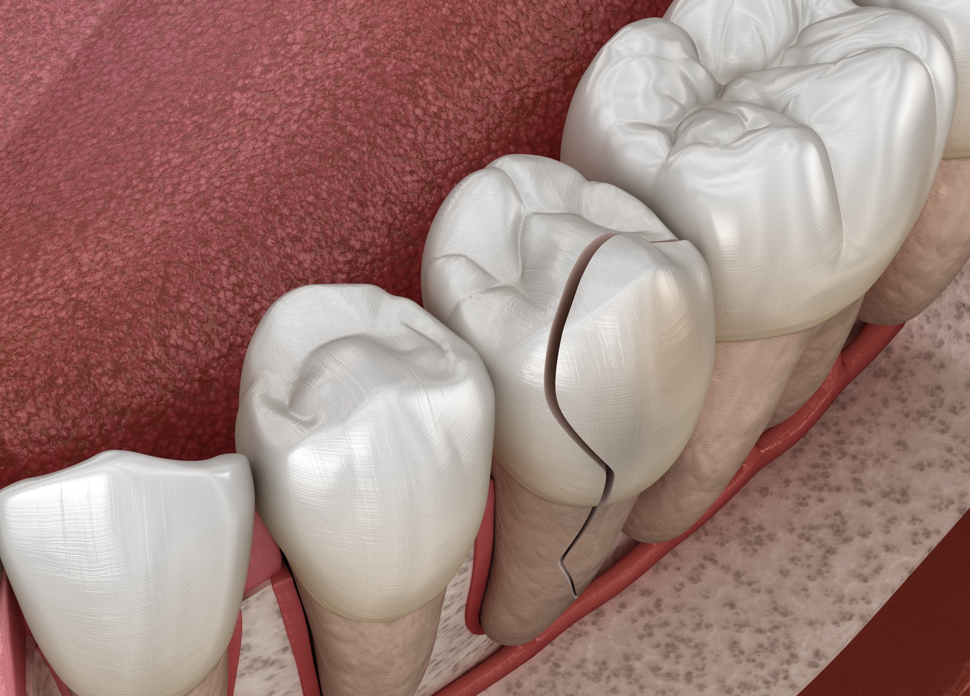 Emergency dental care after a tooth is knocked out